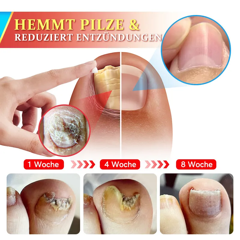 Furzero PsoriaKing Psoriasis Antibakterielle Behandlungscreme