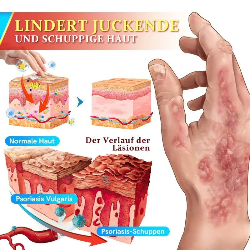 Furzero PsoriaKing Psoriasis Antibakterielle Behandlungscreme